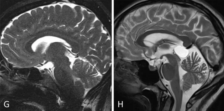 小脑幕倾斜度变异分析:旁正中入路(G)至松果体区的视角轨迹较中线入路(H)更为平缓。