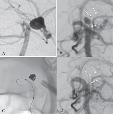 (A)既往 DSA 显示左侧 PCA 未通,无 BA 尖端动脉瘤。 (B)右侧椎体血管造影显示丘脑后穿通动脉(pTPA)动脉瘤。pTPA(白色箭头)起源于闭塞的左侧 P1 孔。 (C&D)采用六个弹簧圈实现了完全闭塞。弹簧圈栓塞后检测到丘脑后方穿通动脉 (白色箭头)。