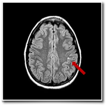 顶叶存在一个小的囊性病变