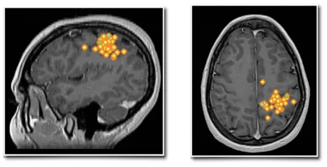 琳娜在矢状位(左)和轴位(右)上显示的Rolandic区(中央区)棘波簇(黄色点带橙色轮廓)。