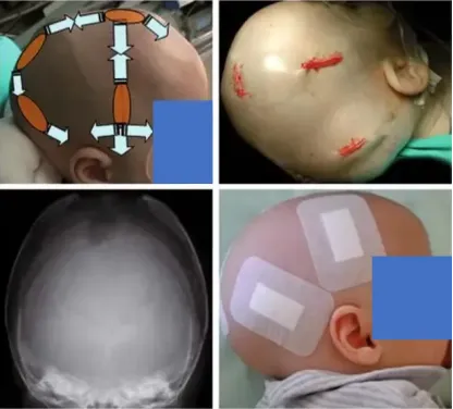 该方法通过在头皮上战略性地分布两至六个短线形切口(每个约2–3厘米长),完成传统的双顶骨扩张术,包括宽范围的矢状缝切除术、沿冠状缝及人字缝的线状颅骨切除术,以及在额骨和枕骨处的桶板状截骨术(如有必要)。此手术无需特殊器械,术后也不需要头模矫形治疗。