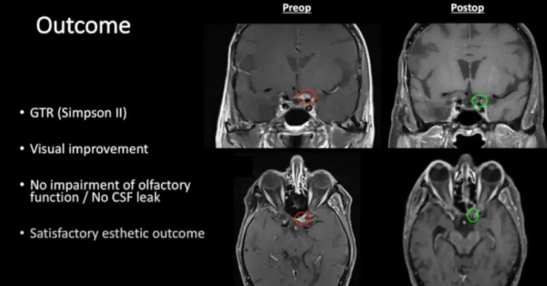 术前及术后磁共振成像。术前preop(A)和术后Postop(C)显示肿瘤完全切除。