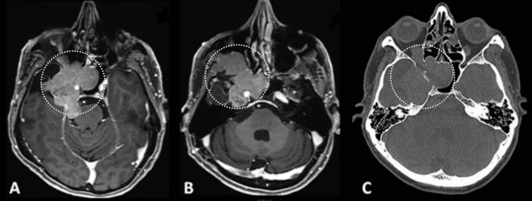 患者术前影像。(A)术前轴位T1加权钆增强磁共振成像(MRI),显示脑膜瘤延伸至后颅窝、海绵窦、眼眶和蝶窦。(B)肿瘤延伸至中颅窝、翼腭窝和颞下窝。(C)术前轴位计算机断层扫描(CT)显示蝶骨大翼侵蚀和蝶窦受累。