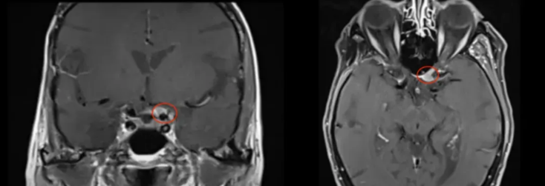 又一个脑膜瘤正压迫视神经管其下侧,威胁着她最后的光明。