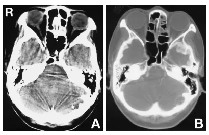 图2A:计算机断层扫描(CT)平扫显示左侧后颅窝内板处一伴钙化的低密度区。B:骨窗CT扫描显示颅骨内板受侵蚀。