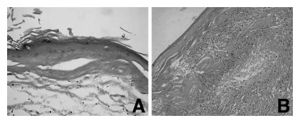 图5,显微照片显示:A硬膜下部分囊壁内衬扁平鳞状上皮,囊腔充满大量角化碎屑;B硬膜外囊壁可见异物巨细胞反应及淋巴细胞浸润。(苏木精-伊红染色,A: ×200,B: ×20)
