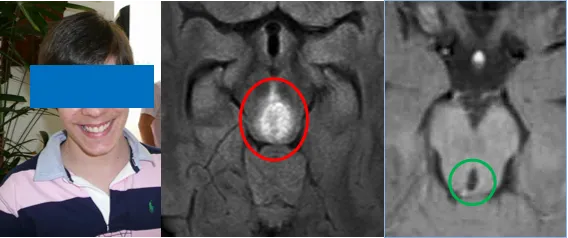 脑干胶质瘤能活多久?