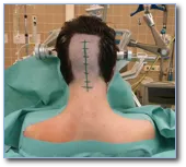 病理显示为WHO Ⅲ级 间变性星形细胞瘤(Anaplastic Astrocytoma)。