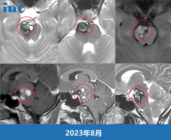 女性脑干海绵状血管瘤患者,怀孕前该先手术吗?