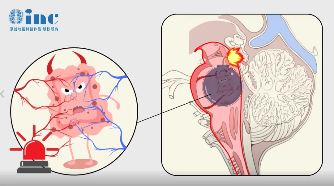 怀孕可能会引发海绵状血管瘤出血。