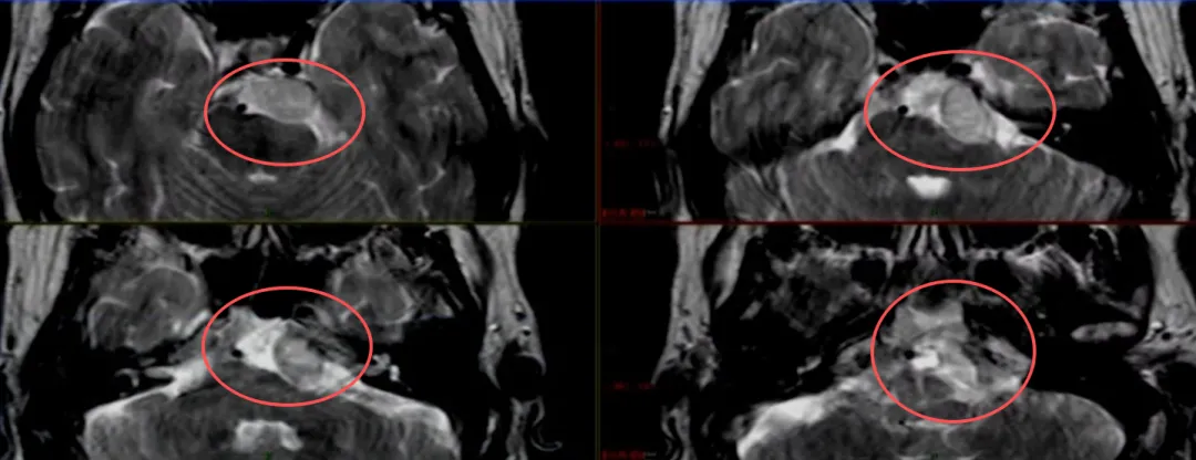 由于肿瘤已侵犯至神经周围区域,术中损伤硬膜内段外展神经的风险非常高。这台手术该怎么做?