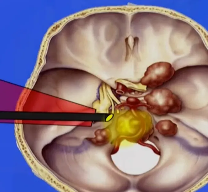 福教授使用岩前入路,尽所能通过前岩骨解剖结构吸出肿瘤,因为肿瘤位置变得很低,低于内听道的位置。