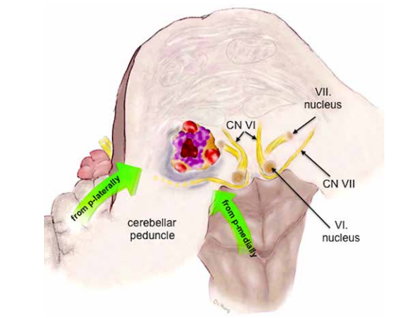桥脑海绵状血管瘤病变位置,血管病变不邻接桥脑表面,但它单侧移动周围的固有结构,包括外展神经和面神经。