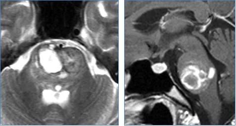 急性头痛、左侧轻偏瘫(2级)、面瘫、严重吞咽困难、卧床不起