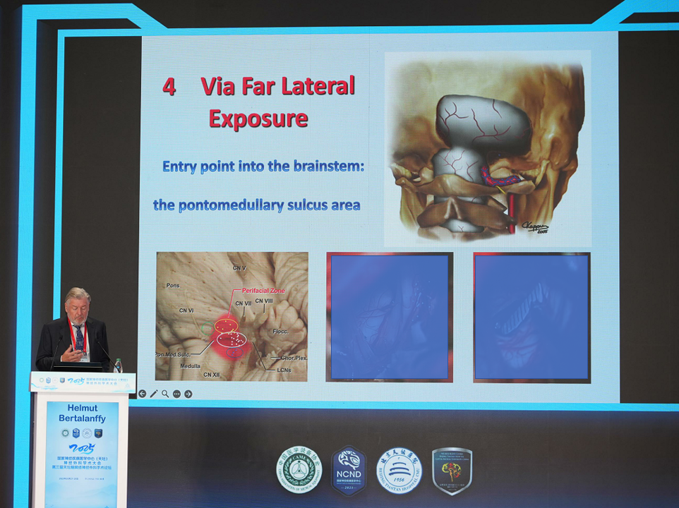 远外侧入路示意图,脑干安全进入区:延髓脑桥沟区域