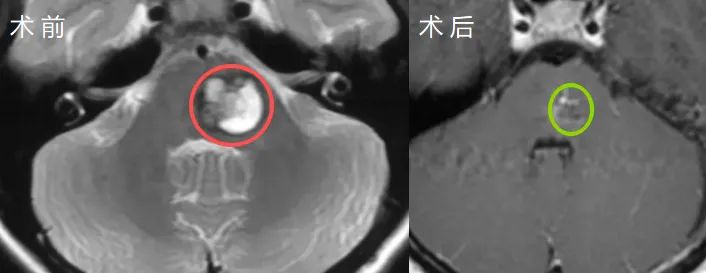 术后第10天,小枝的症状较术前有了明显好转,能够完全自主站立行走,最终顺利出院