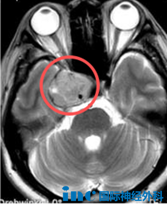 肿瘤位于海绵窦区,大小约2.6*3.0*4.1cm