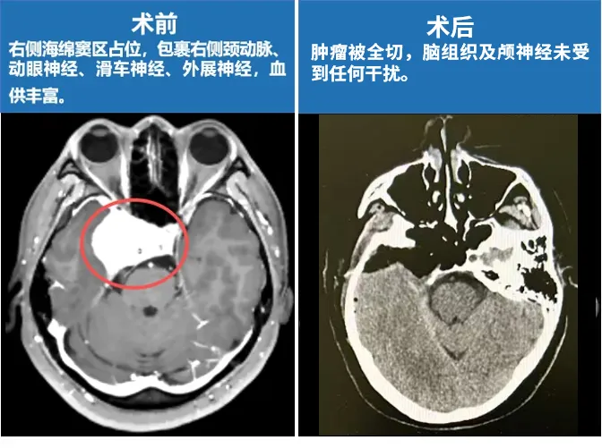 术前术后MRI对比