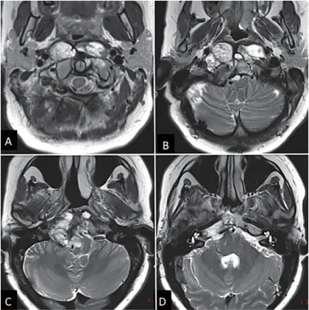 图1：内镜下鼻内镜入路前的术前影像。(A - D) MRI T2 WI显示一个巨大脊索瘤延伸至椎前间隙和齿状突周围。肿瘤横向延伸至舌下管和颈静脉孔，并向内侧延伸至硬膜内间隙。肿瘤从斜坡中部延伸至枢椎齿状突周围。
