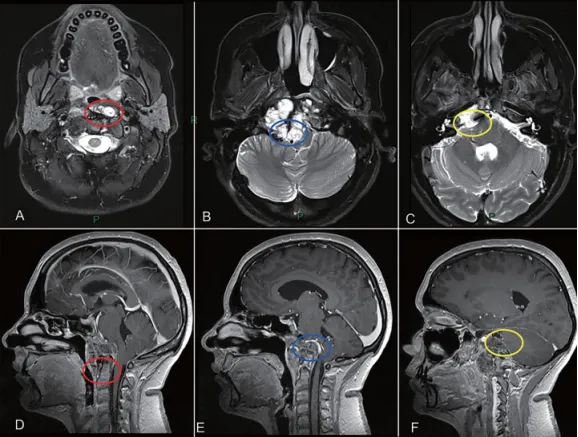 图2：颅颈交界区肿瘤手术治疗策略分析，肿瘤的旁正中部分可以通过经鼻内镜手术切除。枢椎齿状突周边肿瘤（A和D处红色圆圈）、侵犯硬膜内部分的肿瘤与后循环接触（B和E处蓝色圆圈）和先前乙状窦后入路手术的粘连（C和F处黄色圆圈），这些部位的肿瘤更适合第二期远外侧开颅手术。