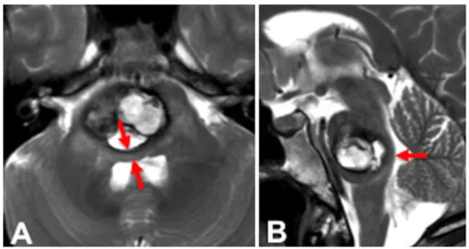 检查显示大出血性 轴内桥脑海绵状血管瘤（A 和 B）。脑桥的背侧结构受到严重压缩（红色箭头），表明仅在病变和菱形窝表面之间有薄薄的实质层。