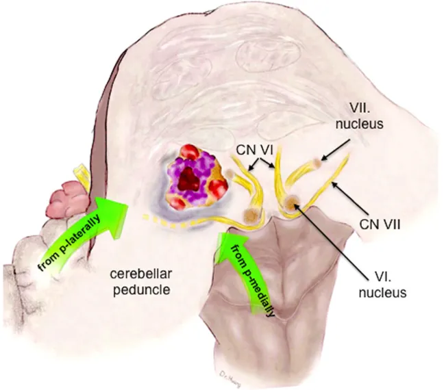 脑桥中部的横断面，并标示了下方的脑桥海绵状血管畸形（PCM）。该血管性病变未紧贴脑桥表面，但单侧性地推移了周围的内在结构，包括外展神经与面神经的神经核团及纤维束。根据解剖学研究，面神经核平均距第四脑室底约5.1毫米，而外展神经核距菱形窝表面的平均距离仅为0.2毫米。绿色箭头指示了抵达此左侧病变的两种可能手术入路：后内侧入路或后外侧入路。p-laterally = 后外侧；p-medially = 后内侧。