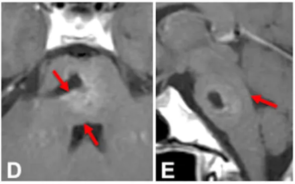 术后影像上记录了切除情况，病灶得到全切（D 和 E）
