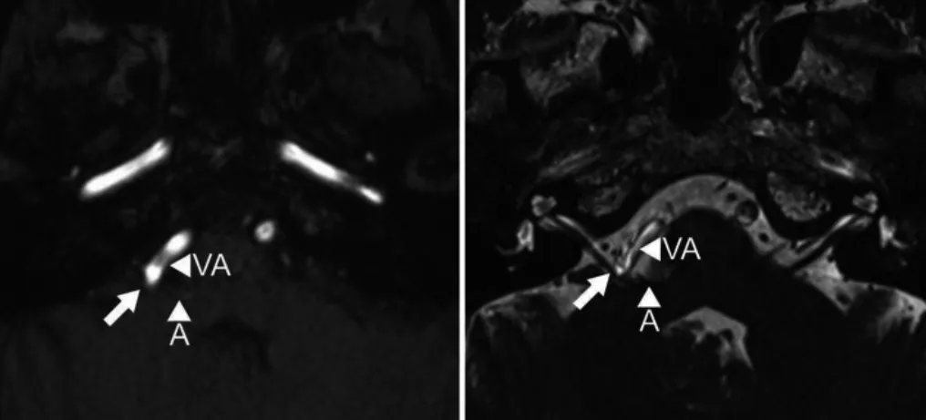 图1,术前MR成像,飞行时间法(左)和稳态构成干涉序列(右)轴位图像显示小脑前下动脉(A)和椎动脉(VA)襻压迫面神经根出脑干区(箭头)。