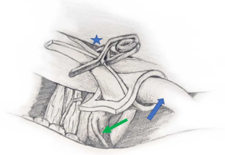 图3,示意图说明使用附着于颅底硬脑膜囊袋(蓝色星号)的微型血管夹对椎动脉(蓝色箭头)进行吊带减压/血管移位技术。处于风险中的穿支动脉以绿色箭头指示。