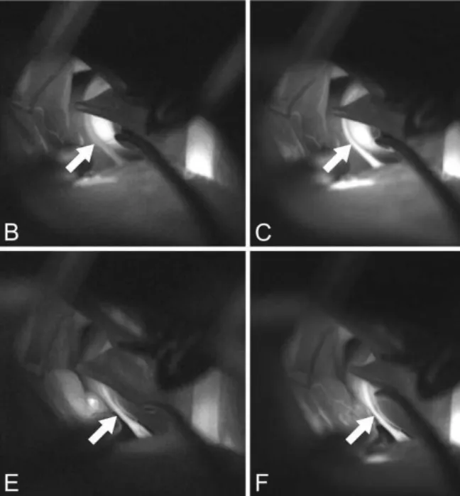图4,随时间变化的显微镜下及术中吲哚菁绿血管造影图像。 B和C 调整前ICG血管造影图像时间序列显示,与VA相比,穿支动脉(箭头)充盈延迟。初始时,当VA已经显影,穿支动脉仍未显影。仅在晚期图像中,穿支动脉与VA及其他血管才均显影。D 松开吊带后,穿支动脉(箭头)的牵拉减轻。E和F 调整后ICG血管造影图像时间序列显示,与VA相比,穿支动脉(箭头)充盈及时。