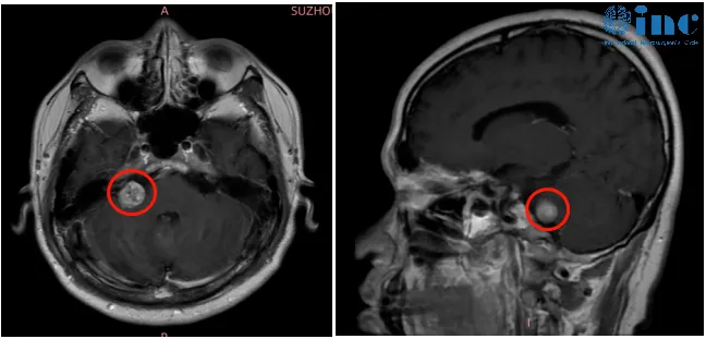 右侧桥小脑角区结节，考虑听神经瘤，且肿瘤大部分深嵌在内听道内。