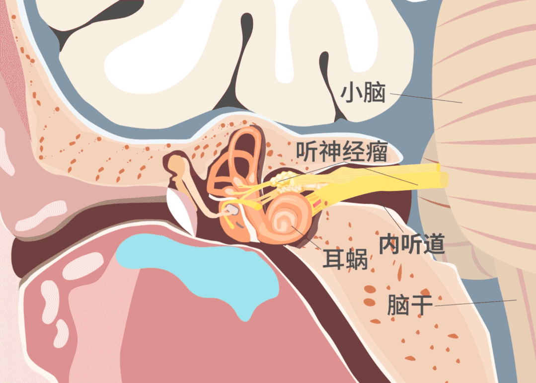 内听道深处的听神经瘤，手术难度堪比在刀尖上跳舞。