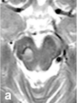 MRI检查提示有轻微再出血（图a），令人惊讶的是，他当时仍然没有任何明显症状。这种“沉默性出血”是脑干海绵状血管瘤的一大特点，也是其危险性的体现。