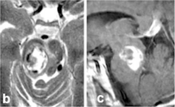 这次出血带来了严重后果。新发出血导致他出现左侧肢体轻偏瘫和感觉减退，右侧外展神经及面神经麻痹，更伴随意识水平下降。