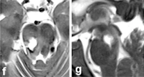 术后影像（图 f-g）和术中记录共同证实，病灶已实现全切，出血得到彻底控制。