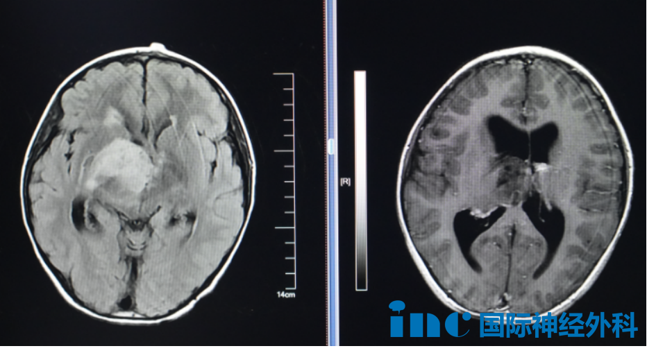 一个尺寸约达4.0cm×4.7cm×4.8cm的病灶，正盘踞在孩子右侧丘脑区域，并已引发脑积水。