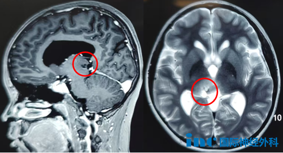13岁男孩丘脑-中脑胶质瘤