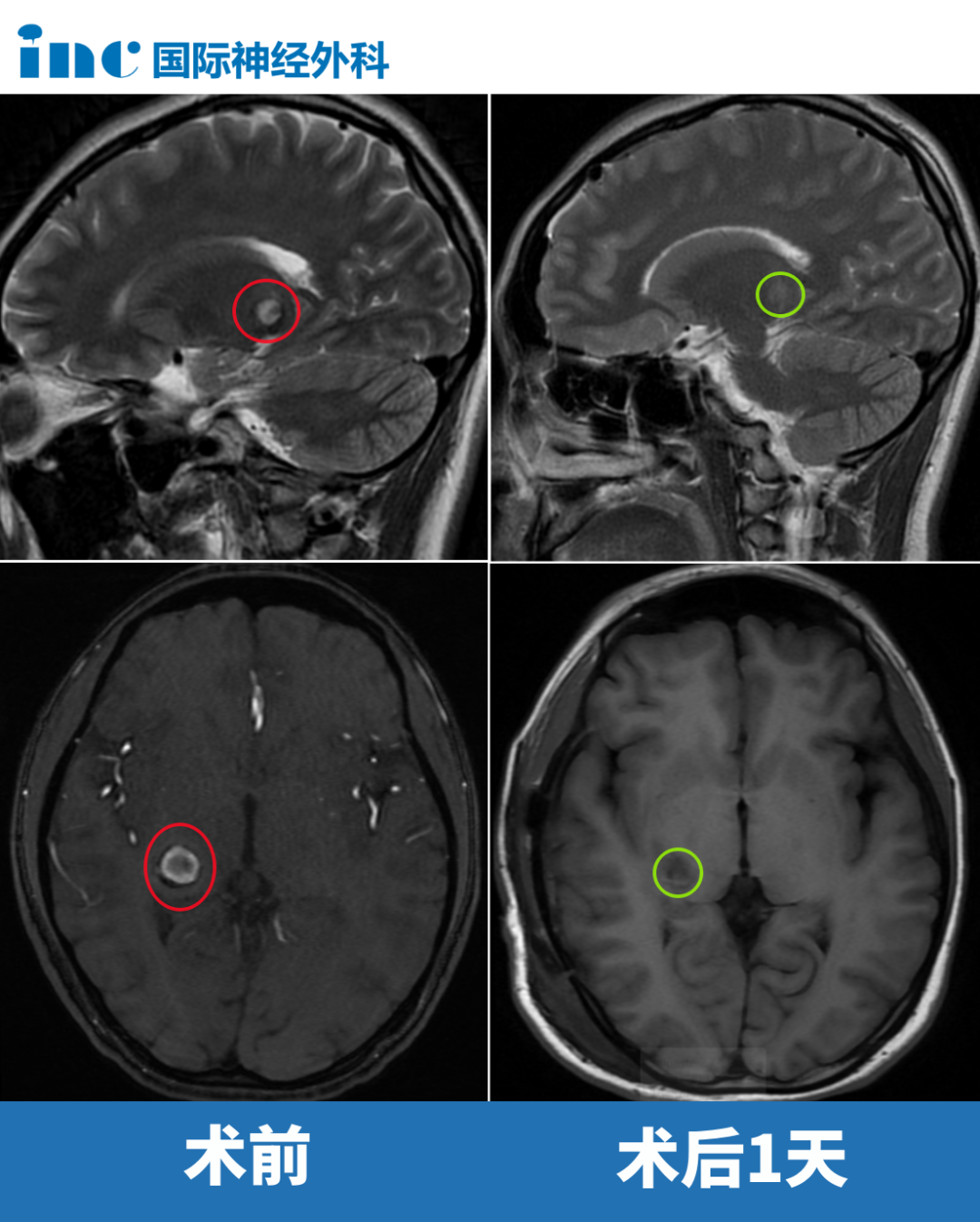 20岁女孩丘脑海绵状血管瘤