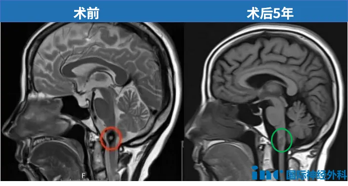 她所患的延髓海绵状血管瘤，位置极其凶险——病变深藏于高位颈髓腹侧，紧贴脑干，而这里正是掌控呼吸与心跳的生命中枢。