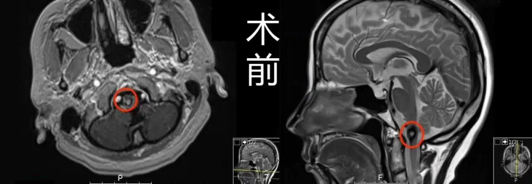 术前MR：延颈髓偏右侧见一直径约1cm占位，周围见环状含铁血黄素低信号影环绕，提示海绵状血管瘤。