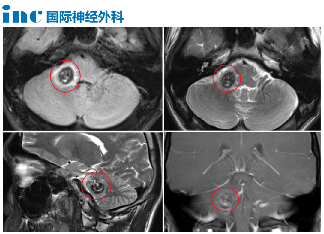 海绵状血管瘤导致的出血，同时还在脑干内病灶周围产生水肿。