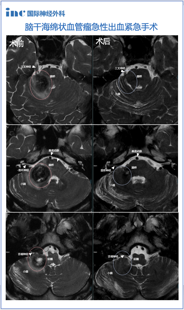 脑干海绵状血管瘤急性出血紧急手术