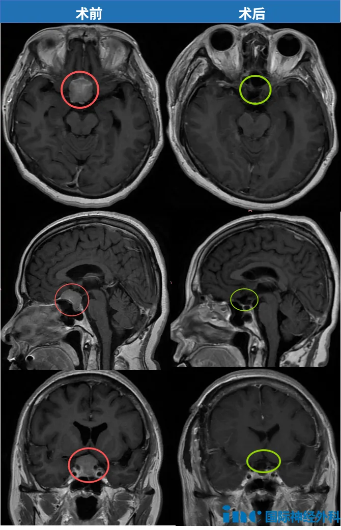 58岁的陈女士罹患鞍区脑膜瘤，不仅位置险要，更已导致视力显著下降。危急关头，为了保住剩余的视力，一家人当机立断，迅速选择手术；巴教授更是精准出击，顺利切除肿瘤，从失明的边缘为她夺回了光明。