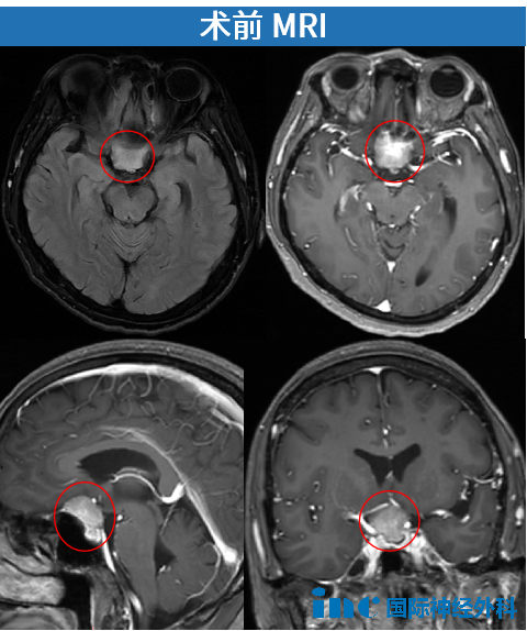 肿瘤匍匐于鞍底，约2.6cm×2.5cm。