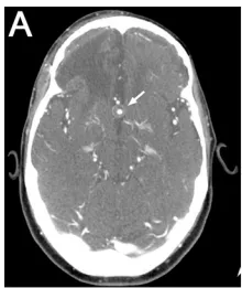 A: 术前CT血管成像显示10.3毫米部分血栓形成的ACoA动脉瘤（箭头）。