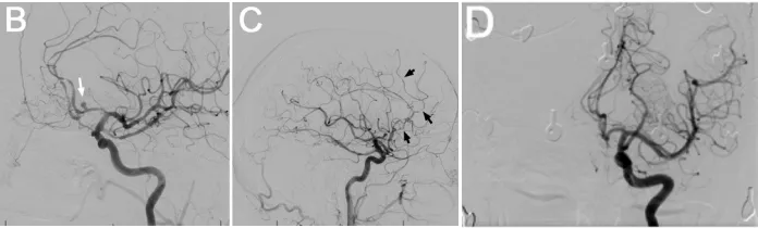 B: DSA侧位像显示动脉瘤（箭头）。C: DSA侧位像显示放射性血管炎，表现为血管分支减少及多处血管狭窄（箭头）。D: DSA正位像显示2年前Wada试验时未见动脉瘤或血管炎性改变。