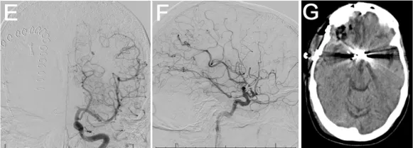 术后DSA显示动脉瘤闭塞有效，无并发症
