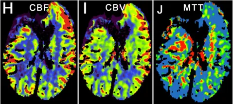 术后脑灌注成像显示一处术前已知的陈旧性脑梗死区域