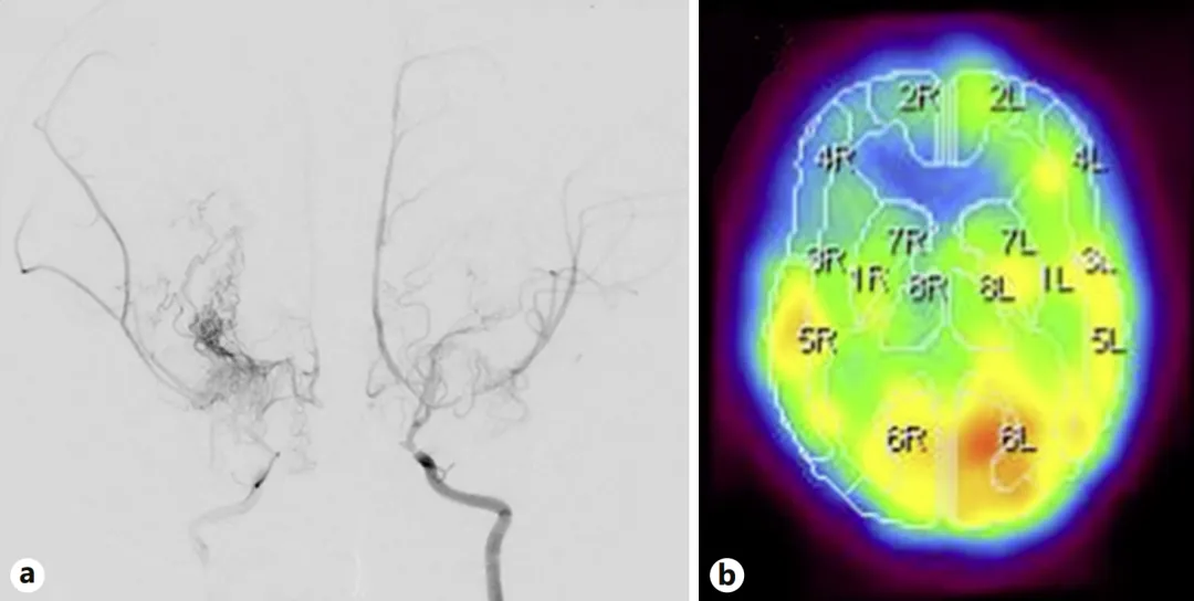 图a，就像三条主干道同时堵车，脑组织正在 “缺氧” 的边缘挣扎。  图b，这解释了她反复猝倒的原因：大脑缺血时，身体会突然失去力量。