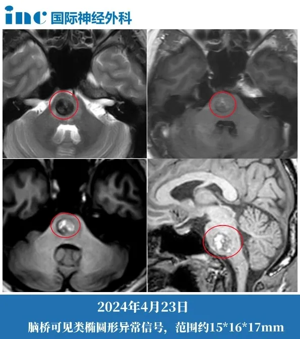 肢体乏力让他连走路都举步维艰,左侧全身的麻木感逐渐蔓延到面部,复视、耳鸣也接连袭来。复查核磁显示,病灶已经扩大到 15×16×17mm